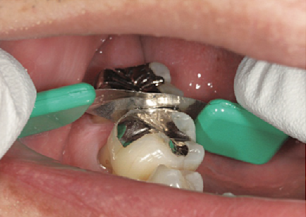 セラミック治療2なら名古屋市天白区の歯医者【イナグマ歯科】