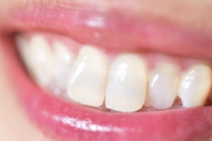 仮歯 女性_コピー