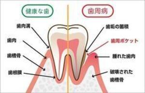 歯周炎_コピー_コピー_コピー