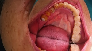 セラミック治療前