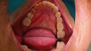 セラミック治療後