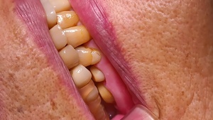 セラミック治療前