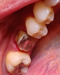 Before  銀歯脱落してジルコニアクラウン装着前