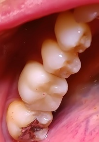 After ジルコニアクラウン装着後 自然な白さ」「金属アレルギー対応」