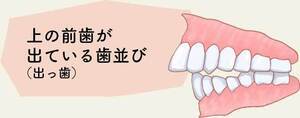 上顎前突 イラスト_コピー