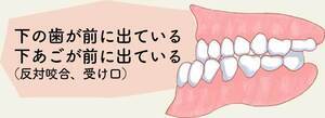 下顎前突 イラスト_コピー