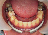 リップバンパー2 写真