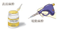 電動麻酔と表面麻酔