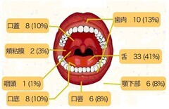 舌がん％_コピー