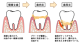 歯周病_