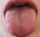 舌痛症_コピー_コピー
