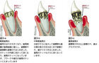 歯周炎