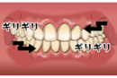 歯ぎしり_コピー_コピー