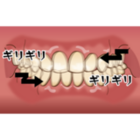 歯ぎしり_コピー