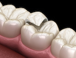 Lost ceramic teeth_238242132