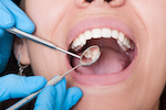 tooth decay_76368355