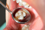 Decayed teeth_194548615