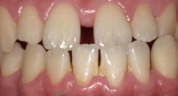 歯に歯石がついている_コピー