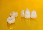 what-is-ceramic-treatment_85479885_M-scaled