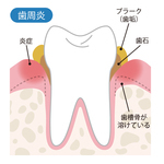 歯周病と歯石