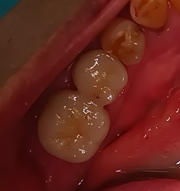 After ジルコニアクラウン装着後