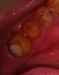 Before ジルコニアクラウン装着前_コピー