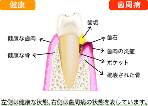 歯周病の歯肉と健康な歯肉の比較