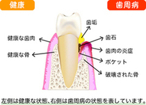 歯周病の歯肉と健康な歯肉の比較_コピー_コピー_コピー
