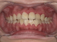 上下の歯に歯石がついている