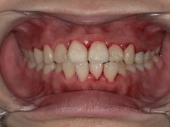 上下の歯の歯石を取ったところ