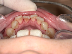 下の歯の歯石を取った