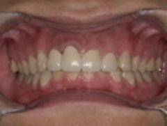 セラミック治療・ジルコニア治療後