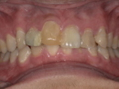 セラミック治療・ジルコニア治療前