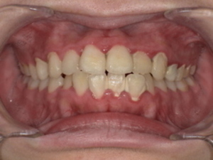 上下の歯に歯石がついている Before(歯石除去前) 下の前歯裏側にびっしりと付着した茶褐色の歯石が、歯間まで覆っています。表面が粗く、不衛生な印象を与えています。