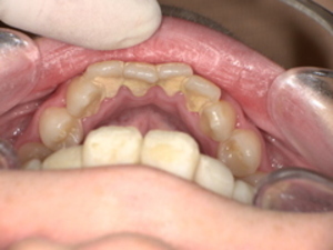 下顎の歯に歯石がついている Before(歯石除去前) 下の前歯裏側にびっしりと付着した茶褐色の歯石が、歯間まで覆っています。表面が粗く、不衛生な印象を与えています。