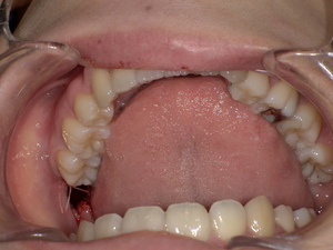 After( 横に生えた状態で埋まっている親知らずの抜歯後 虫歯がある親知らずの抜歯後)