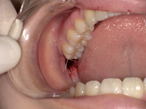 After(After( 横に生えた状態で埋まっている親知らずの抜歯後 虫歯がある親知らずの抜歯後)