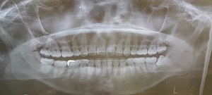 左下親知らずが横になって埋まっている。抜歯前のレントゲン像