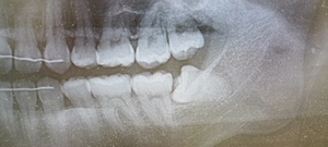 左下親知らずが横になって埋まっている。抜歯前のレントゲン像
