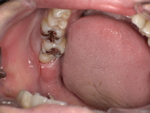 横になった親知らずの抜歯前