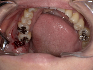 横になった親知らずの抜歯後