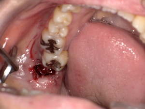 横になった親知らずの抜歯後