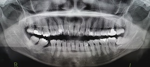 横になった親知らずの抜歯前