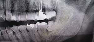 横になった親知らずの抜歯前