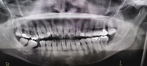 横になった親知らずの抜歯後