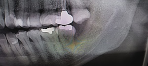 横になった親知らずの抜歯後