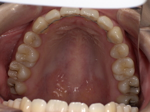左上の親知らず 虫歯がある親知らず