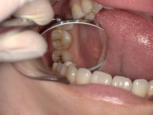 上の親知らず 虫歯がある上の親知らず