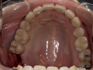 抜歯後の上の親知らず