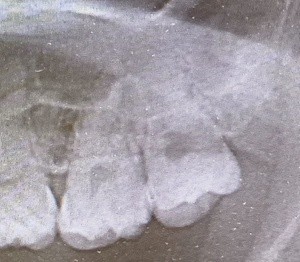 上の親知らず　虫歯になっている上の親知らず